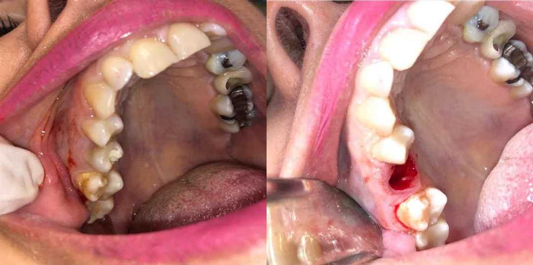 Относительные показания к удалению зуба