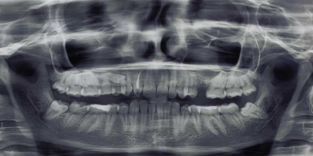 Признаки удаления зуба