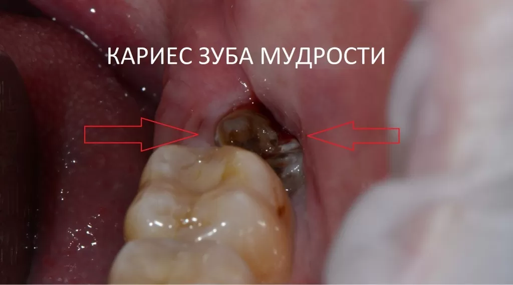 Удаление зубов в Ростове-на-Дону