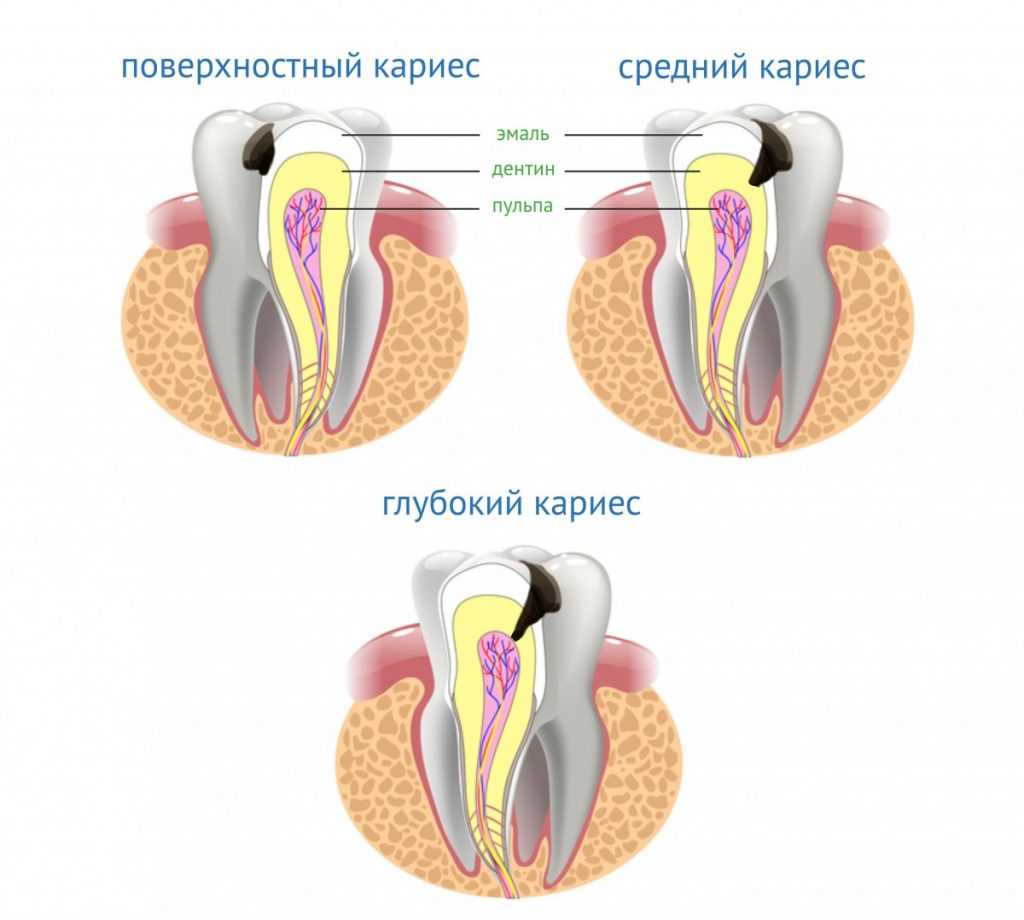 Профилактика и лечение глубокого кариеса — эффективные методы предотвращения и терапии впадин на зубах