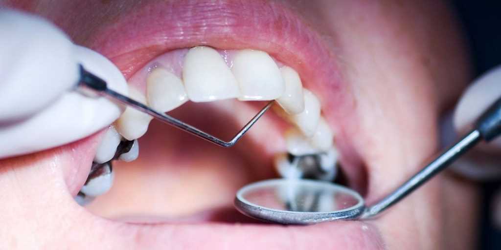 Профилактика и лечение кариеса — здоровые зубы на всю жизнь