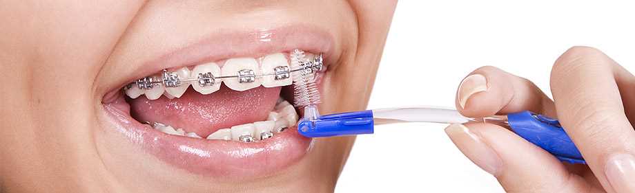 Профилактика стоматологических заболеваний во время ортодонтического лечения