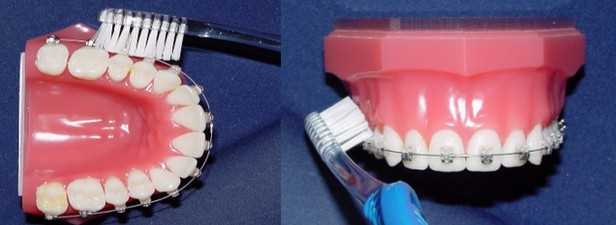 Профилактика кариеса при ортодонтическом лечении