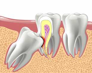 Чем отличается простое удаление зуба от сложного?