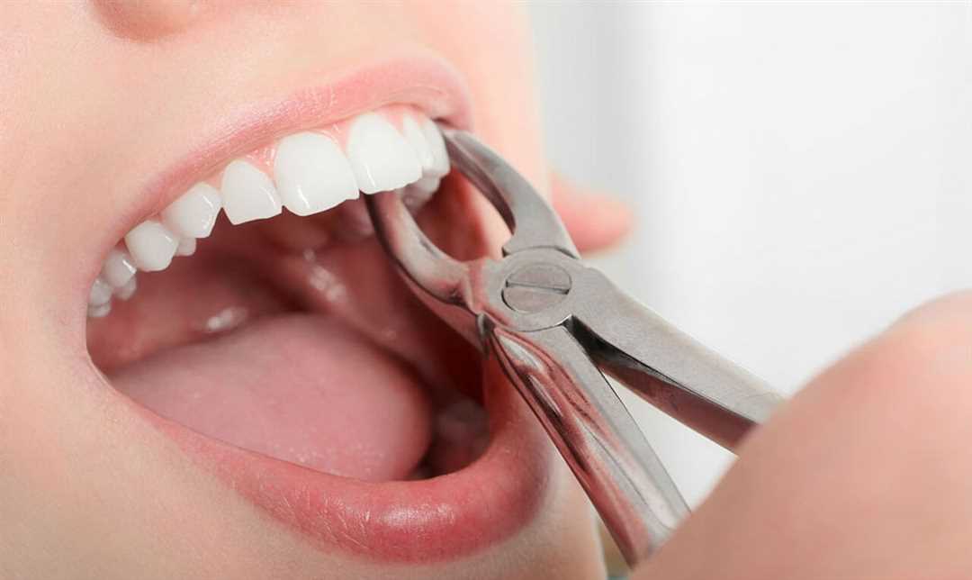 Удаление зуба простое