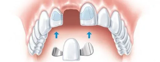 Протез после удаления зуба