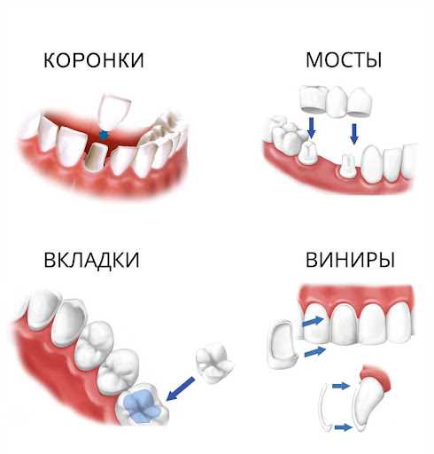 Виды зубных протезов на один зуб при разрушениях