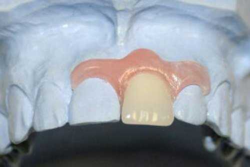 Протезирование 24 зуба