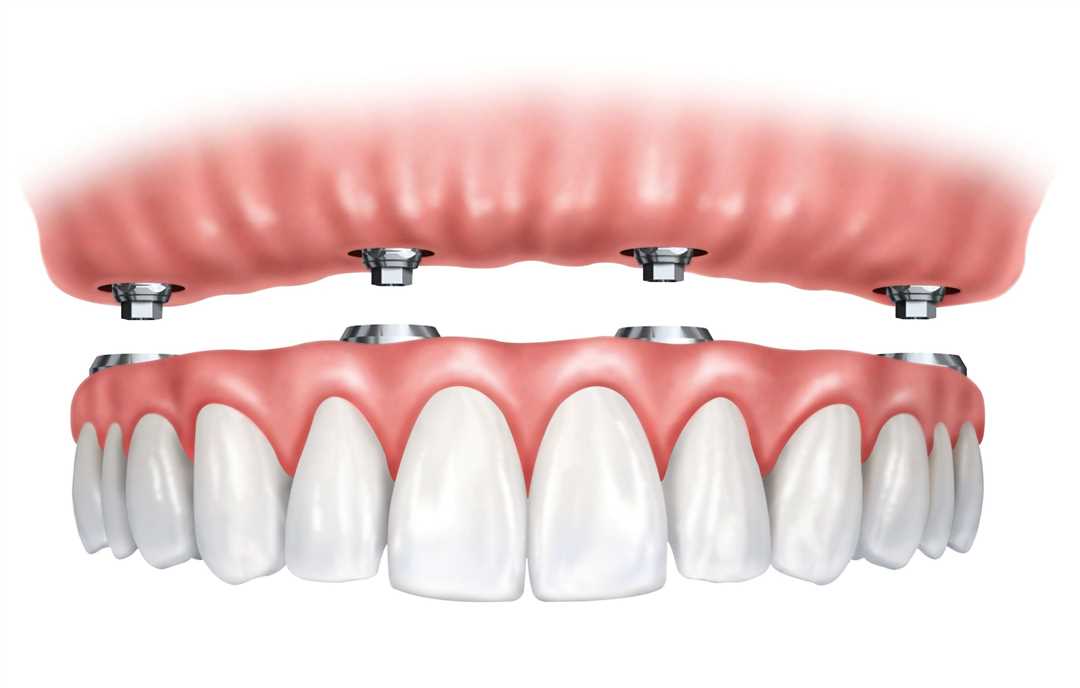 Протоколы имплантации для трех зубов