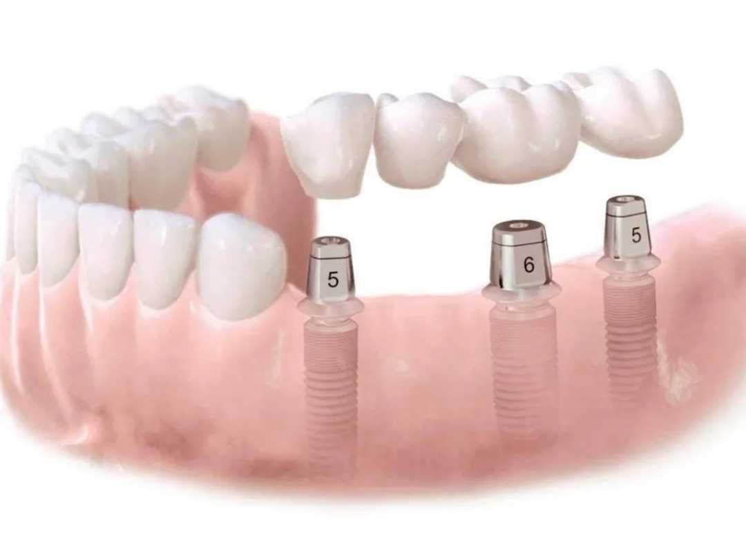 Протезирование 3 зубов