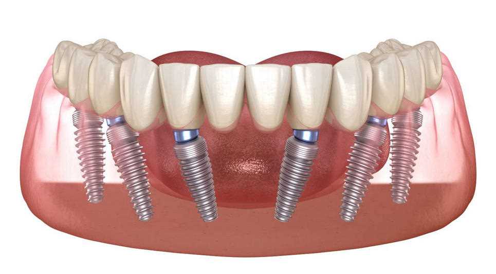 Протезирование шести зубов — как восстановить улыбку и функциональность с помощью современных методов стоматологии