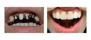 Протезирование двух передних зубов