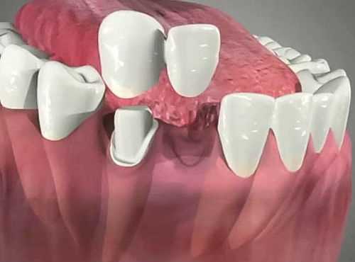 Какой способ протезирования 2 зубов лучше