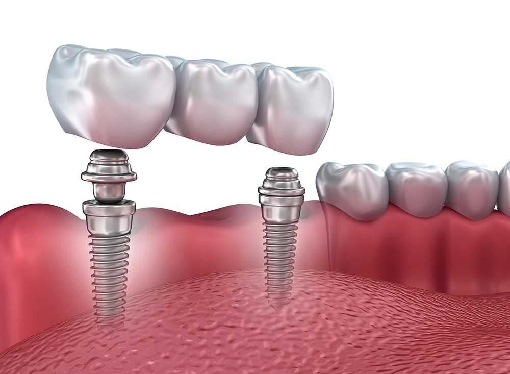 Протезирование двух зубов — современные технологии и их преимущества