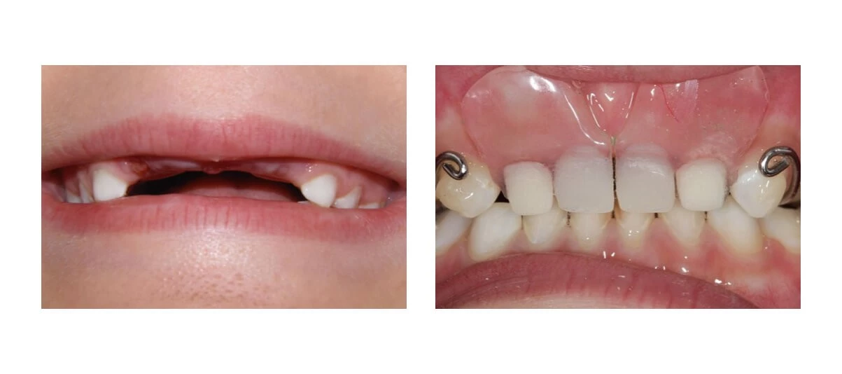 Этапы протезирования молочных зубов и сроки эксплуатации детских протезов.
