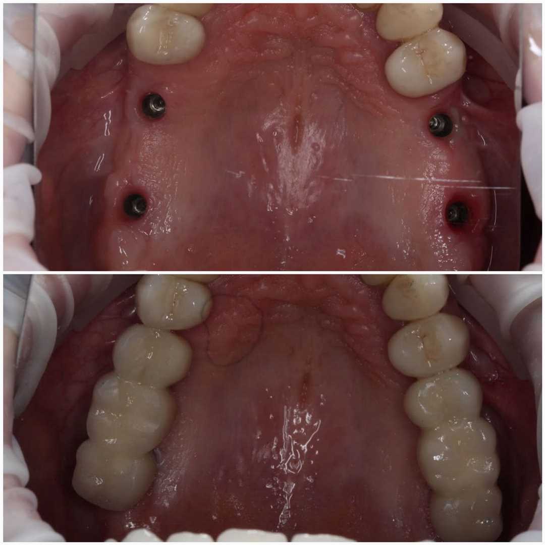 Протезирование молочных зубов детей — высокотехнологичное решение проблемы полостей рта в клинике kosmo dent
