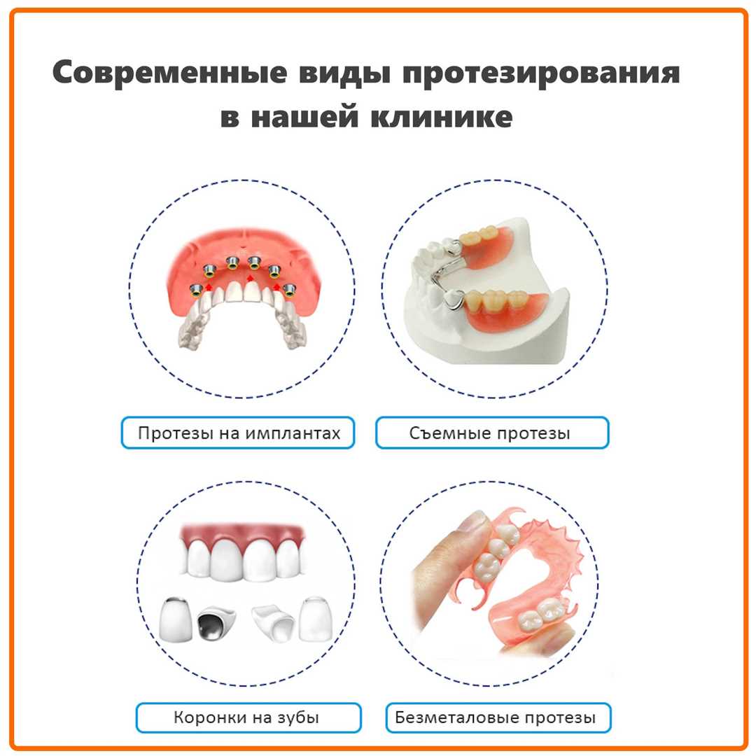 Протезирование на имплантах при отсутствии зубов