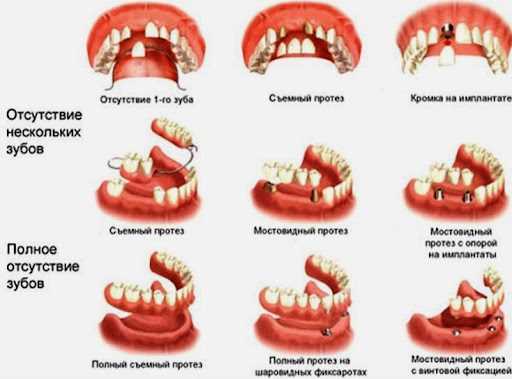 Протезирование нескольких зубов