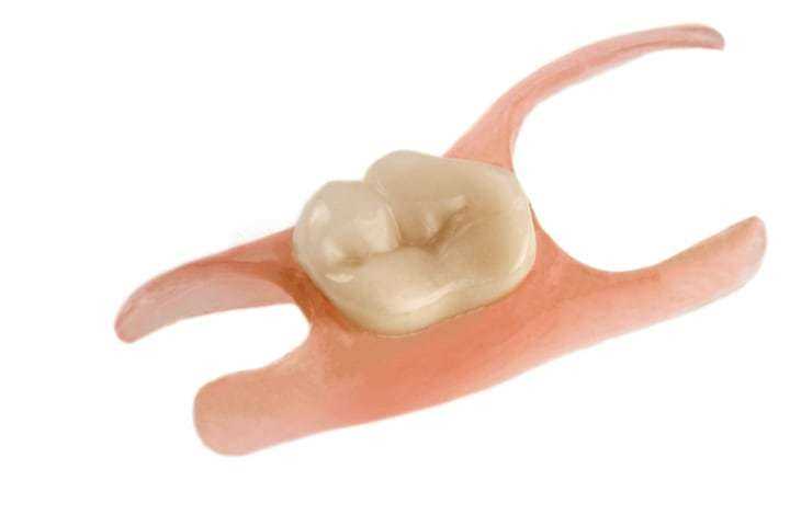 Мостовидный протез при протезировании разрушенных жевательных зубов