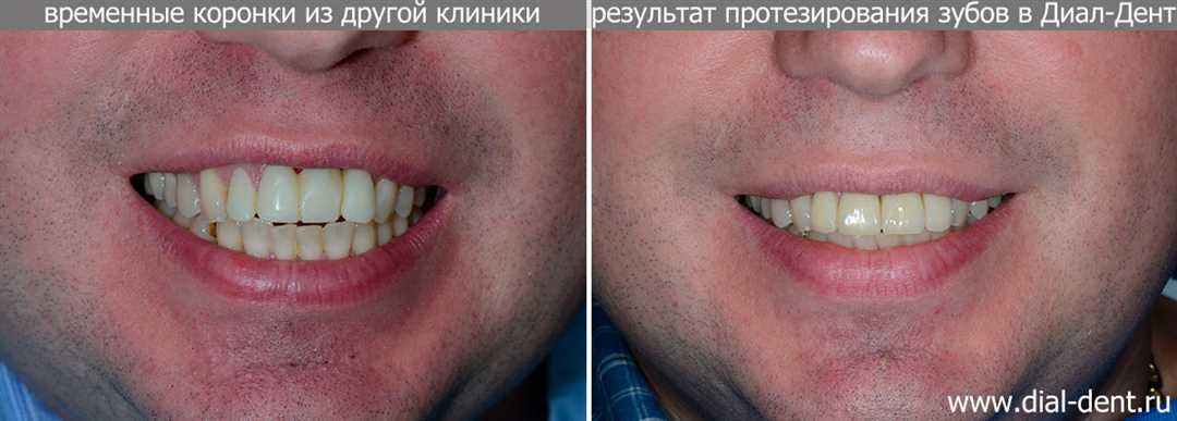 Виды и способы протезирования передних зубов