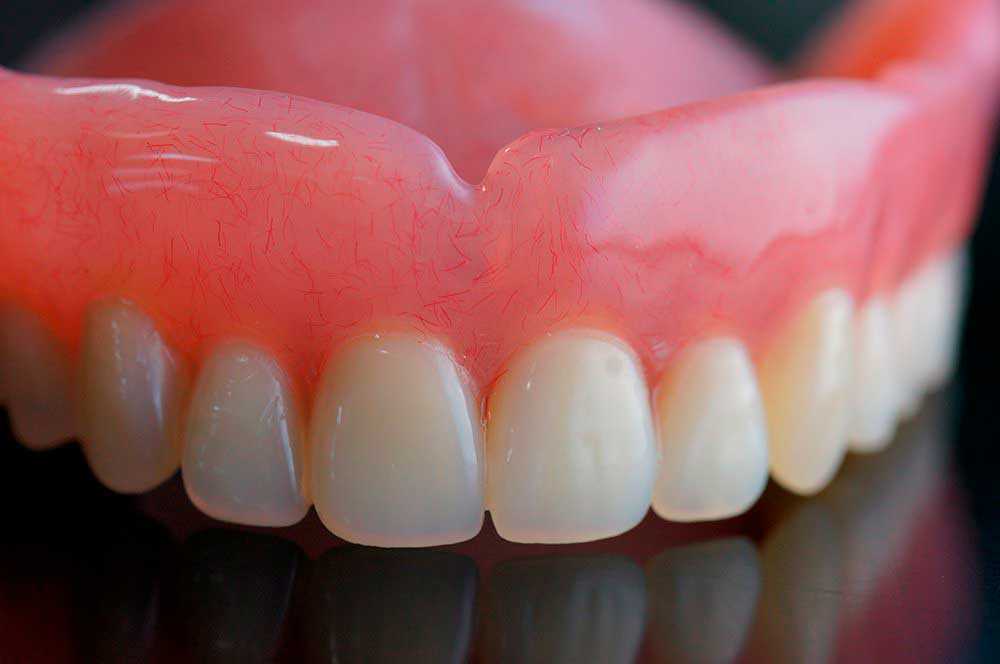 Протезирование центральных зубов