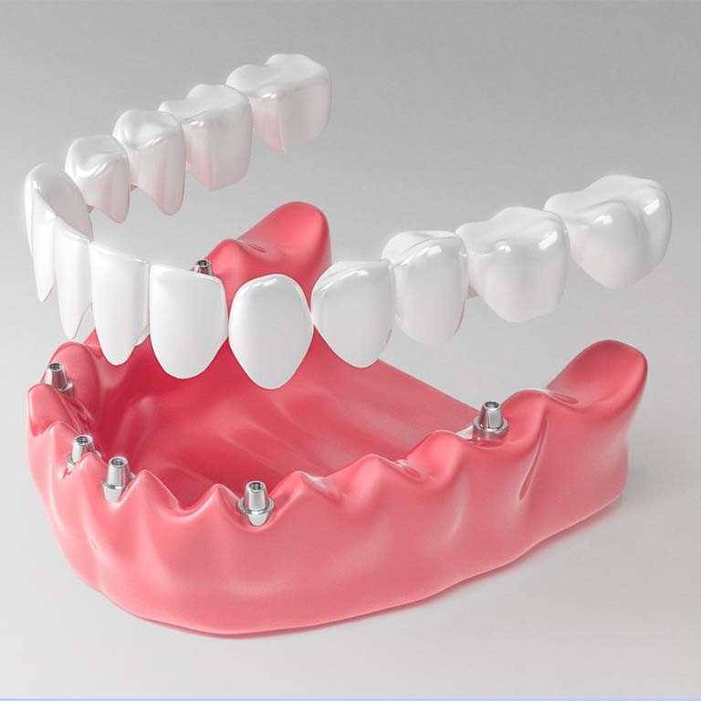 Протезирование зубов в восьмидесятые годы — новейшие технологии и результаты