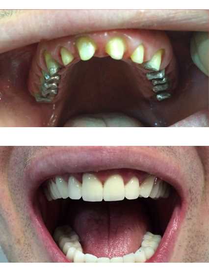 Протезирование зубов без неба