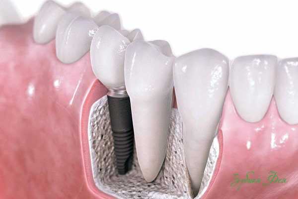 Протезирование зубов — насколько болезненной является данная процедура и как можно снизить боль?