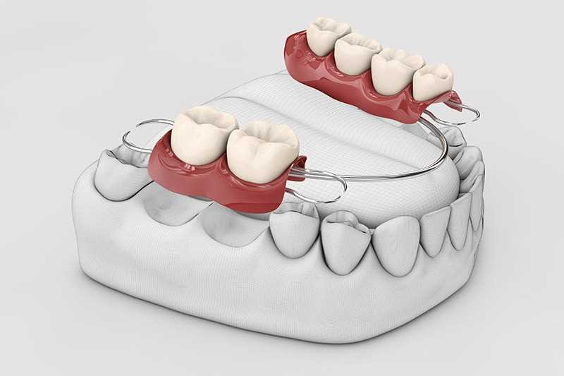 Аристократ Протезирование зубов 