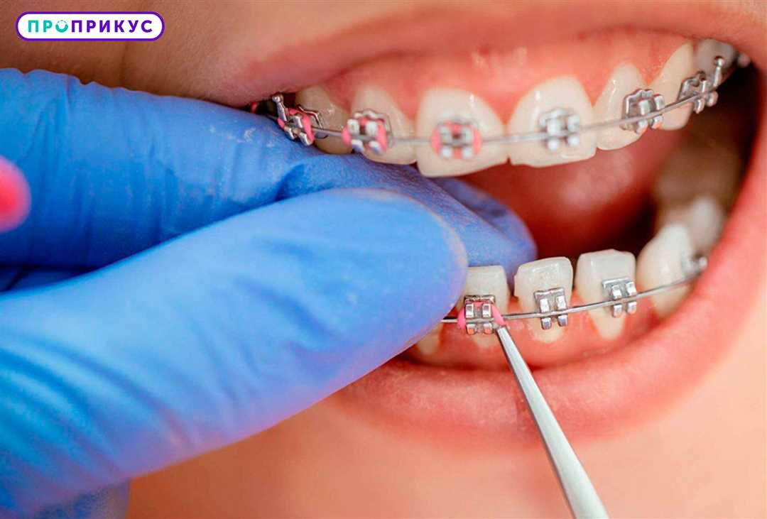 Как брекеты помогают протезировать зубы и сделать улыбку прекрасной?