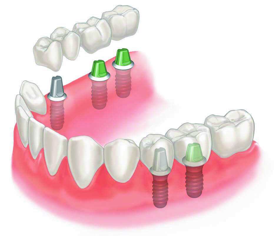 Протезирование зубов дантистофф