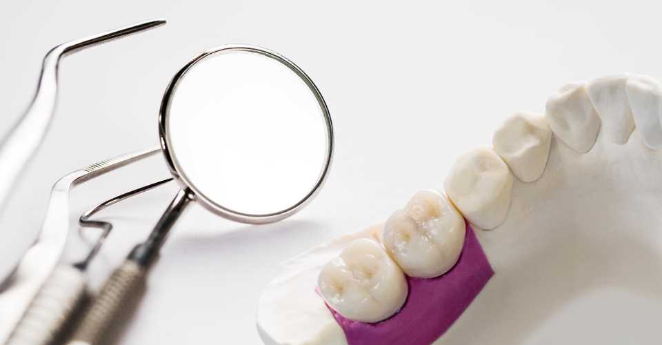 Протезирование зубов в СПб: какие протезы лучше