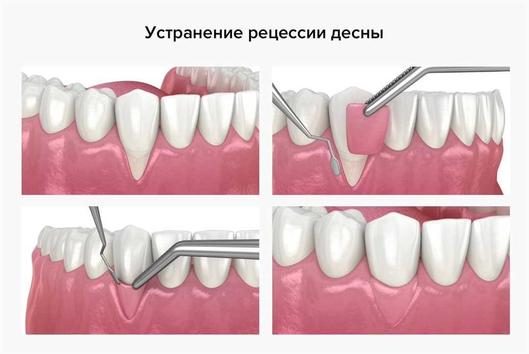Что делать, если зубной протез натирает десну