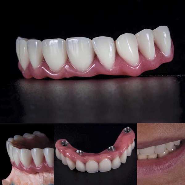 Протезирование зубов дикция