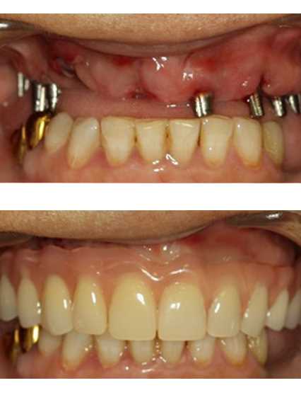 Установка коронок из диоксида циркония на 3 центральных зуба