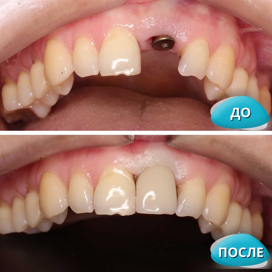 Протезирование зубов — как это происходит до и после, основные этапы