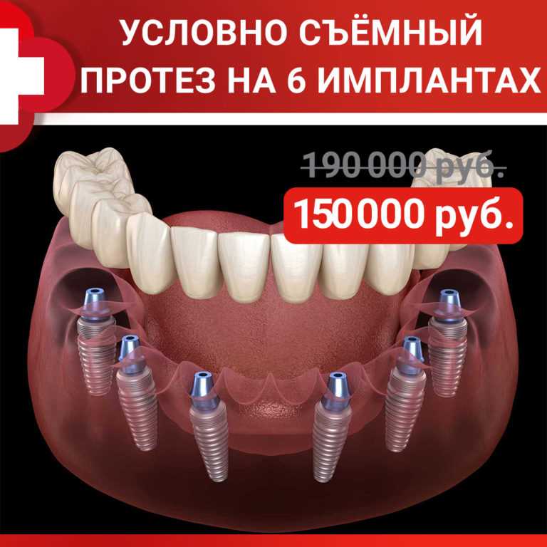 Качественное протезирование зубов в Калининском районе — эффективные методы и современные технологии