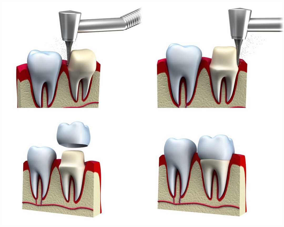 Протезирование зубов коронками — восстановление красоты и функциональности зубного ряда без страха и ограничений