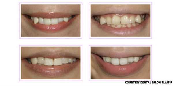 Протезирование зубов кривые зубы