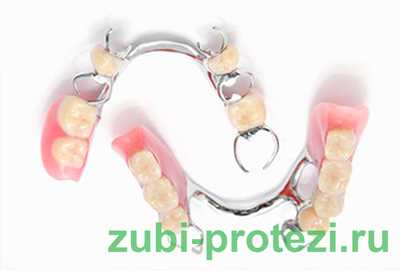 Протезирование зубов крючки