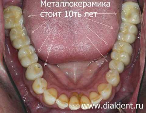 Протезирование зубов металлокерамика