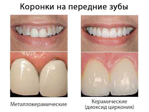 Протезирование зубов в “Современной стоматологии - С”