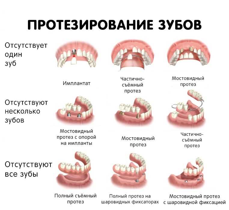 Протезирование зубов мост — техника, преимущества и основные этапы установки