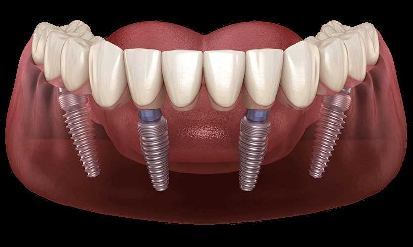 Процесс имплантации зубов на 4-х имплантатах по этапам