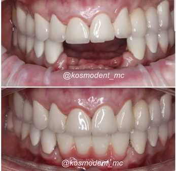 Протезирование зубов на имплантах kosmo dent
