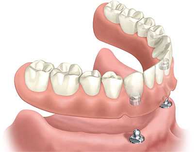 Протезирование зубов на имплантах — инновационное решение для восстановления функции и эстетики полости рта