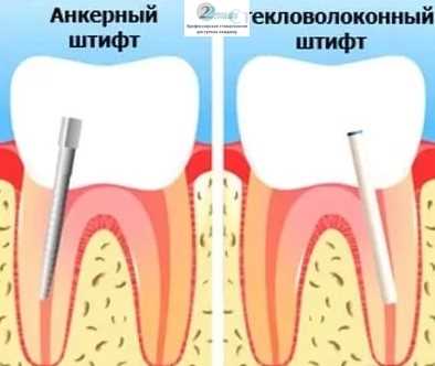 Как проходит процедура по установке зубного штифта?