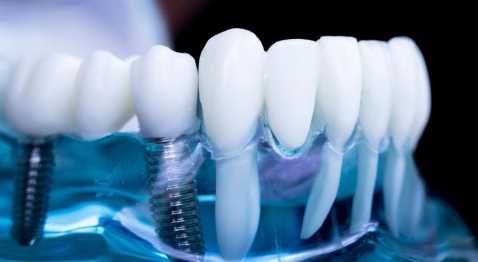 Съемные зубные протезы в стоматологиях Набережных Челнов