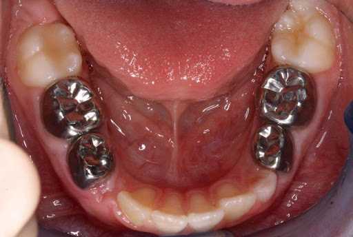 Как протезирование зубов в набережных может вернуть вам уверенную улыбку и здоровье полости рта?