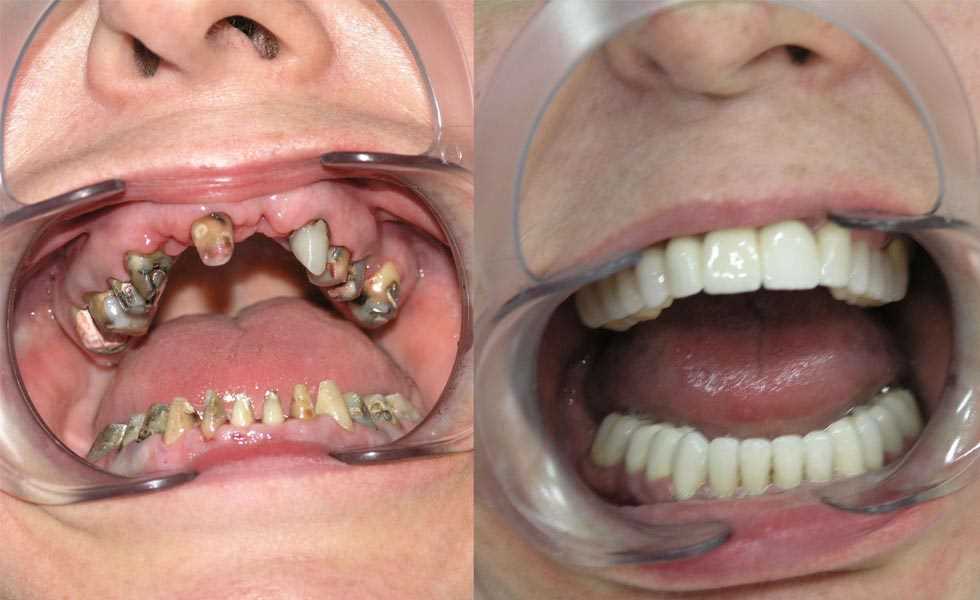 Как осуществляется протезирование зубов нижней челюсти?